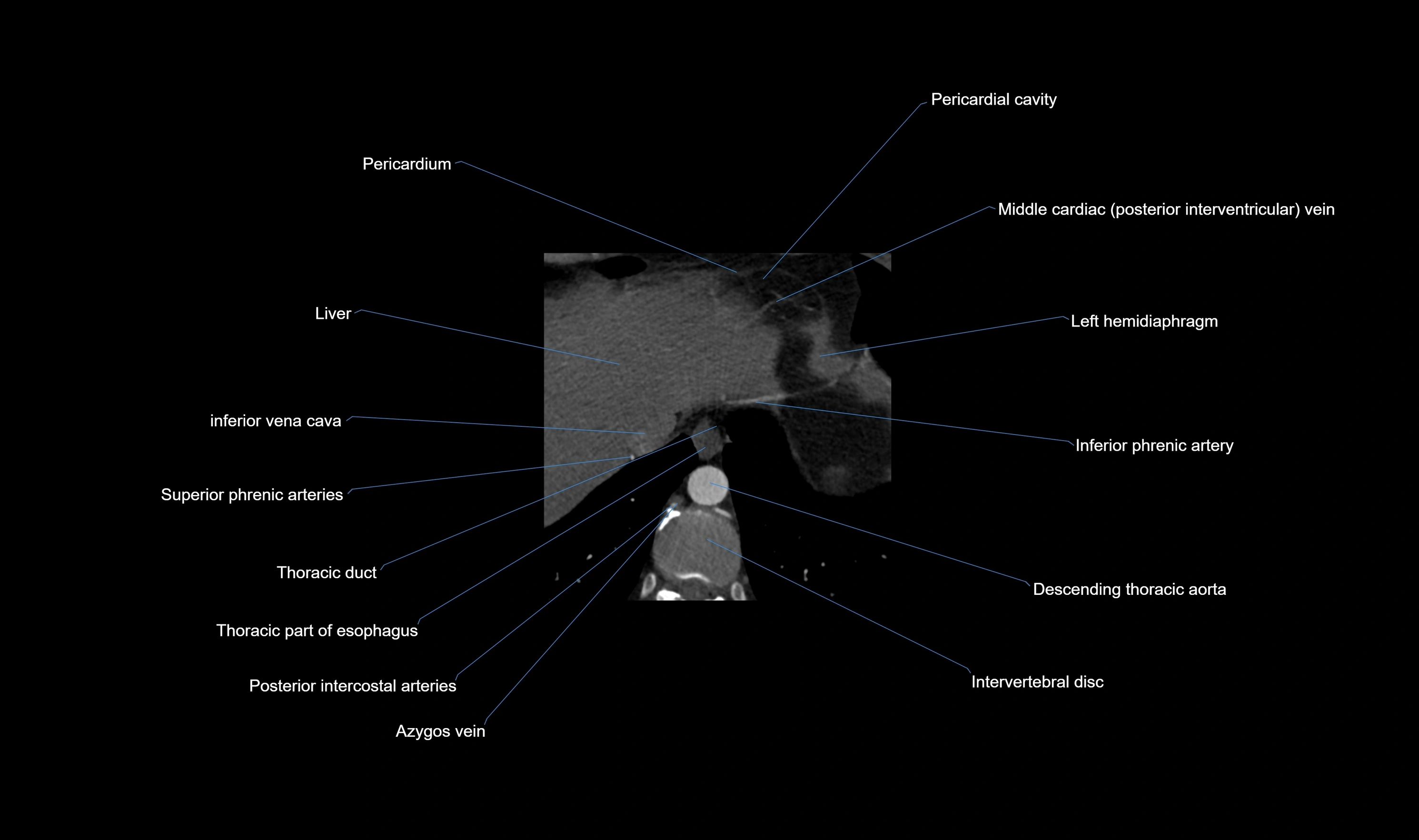 CT heart (coronary angiogram) axial view cross sectional anatomy labelled radiology image-00067.webp